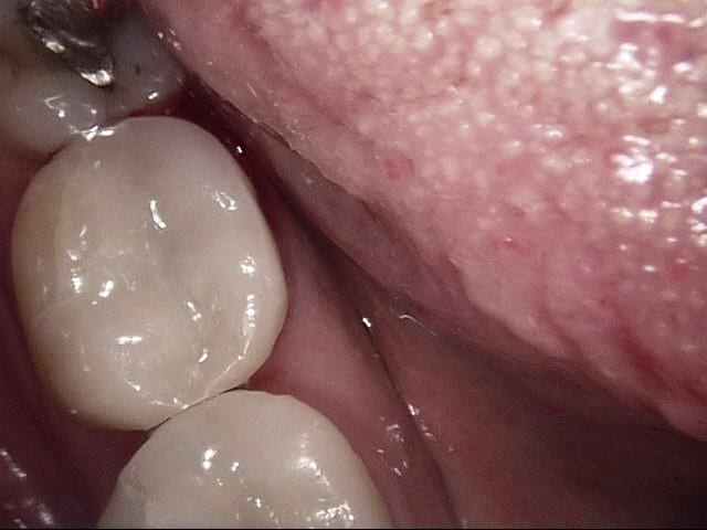 Composite crowns after, Wellington patient at Thorndon Dental