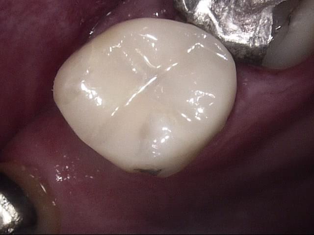 Composite crowns after, Wellington patient at Thorndon Dental