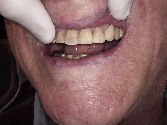 Composite crowns after, Wellington patient at Thorndon Dental
