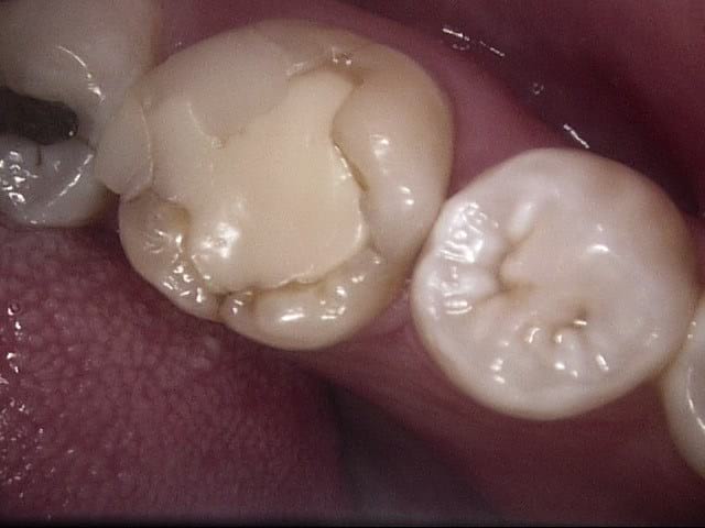 Composite crowns before, Wellington patient at Thorndon Dental