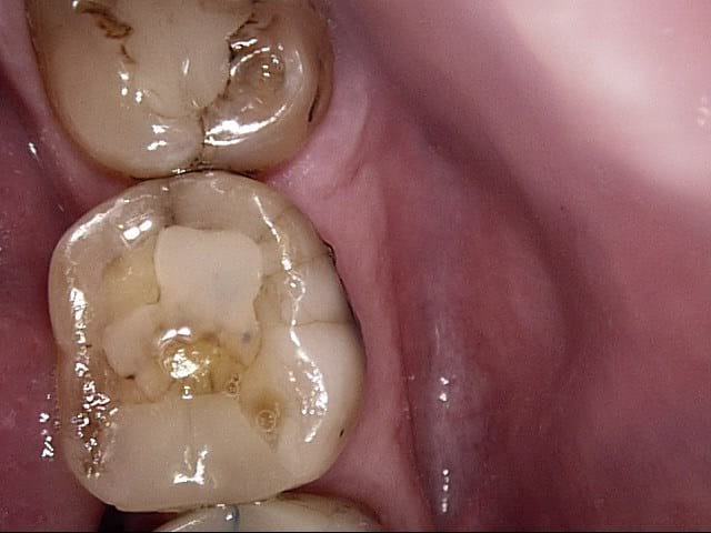 Composite crowns before, Wellington patient at Thorndon Dental