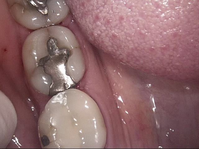 Composite crowns before, Wellington patient at Thorndon Dental