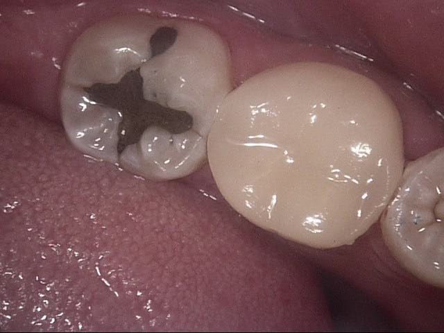 Composite crowns after, Wellington patient at Thorndon Dental