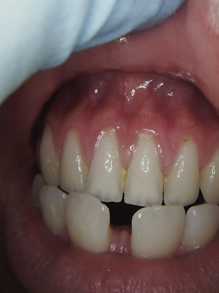 Diastema (gap) closure before, Wellington patient at Thorndon Dental