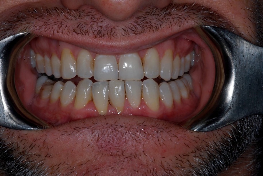Diastema (gap) closure after treatment, Wellington patient at Thorndon Dental