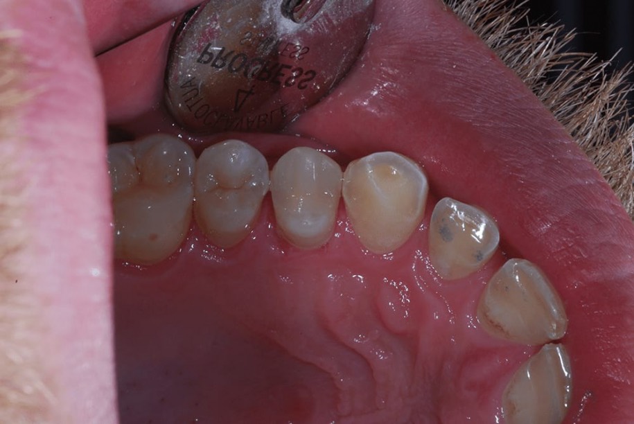 Fillings after, Wellington patient at Thorndon Dental