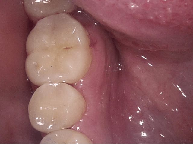 Fillings after treatment, Wellington patient at Thorndon Dental