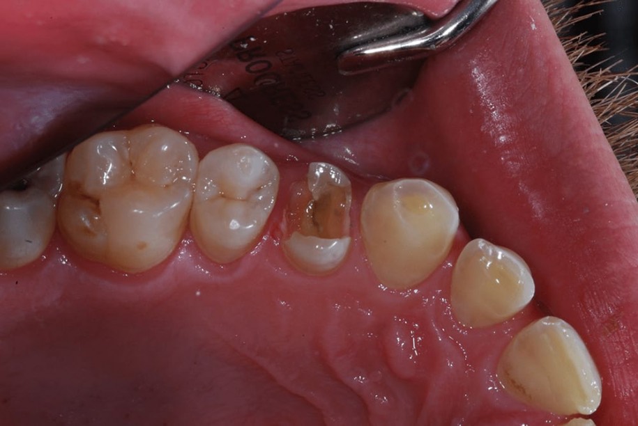 Fillings before, Wellington patient at Thorndon Dental