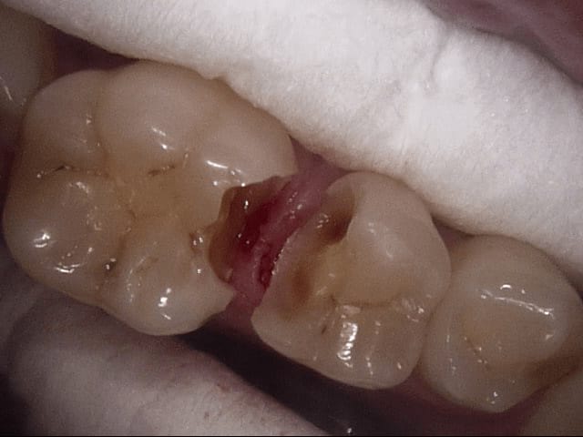 Fillings before, Wellington patient at Thorndon Dental