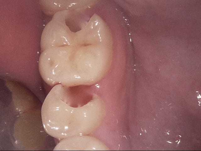 Fillings before, Wellington patient at Thorndon Dental