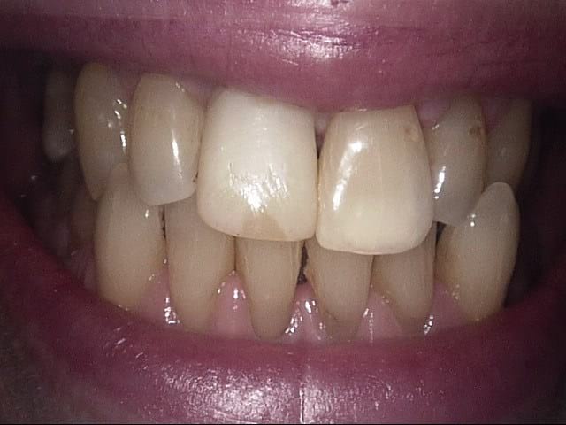 Implants after, Wellington patient at Thorndon Dental