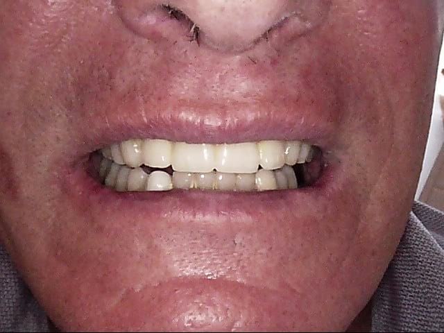 Implants after, Wellington patient at Thorndon Dental