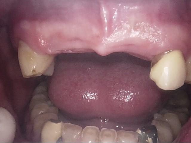 Implants before, Wellington patient at Thorndon Dental