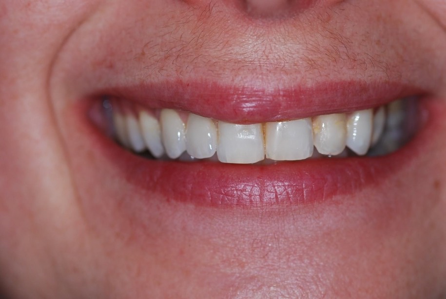 Implants after treatment, Wellington patient at Thorndon Dental