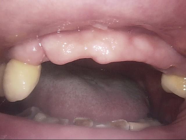 Implants before, Wellington patient at Thorndon Dental
