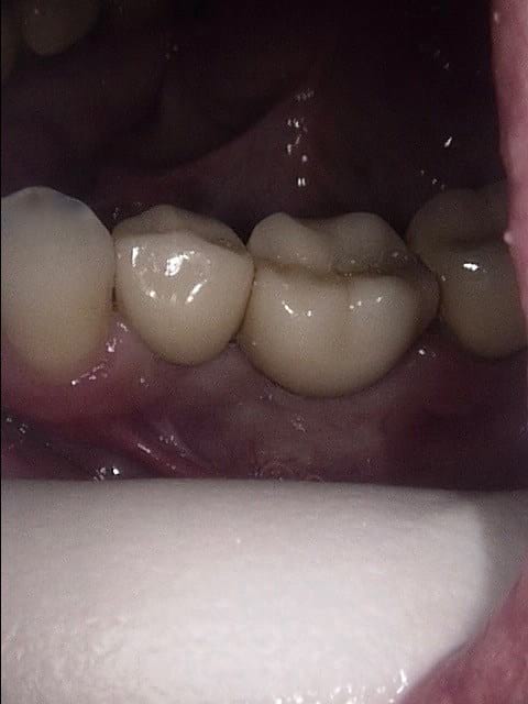 Implants after, Wellington patient at Thorndon Dental