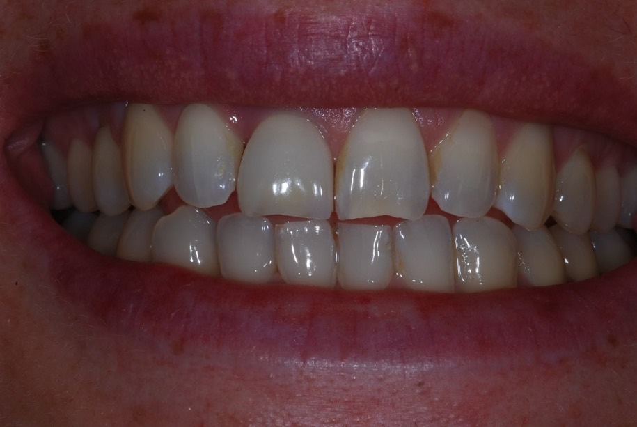 Implants after, Wellington patient at Thorndon Dental
