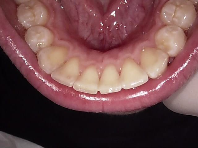 Inman aligner after, Wellington patient at Thorndon Dental