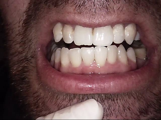 Inman aligner after, Wellington patient at Thorndon Dental