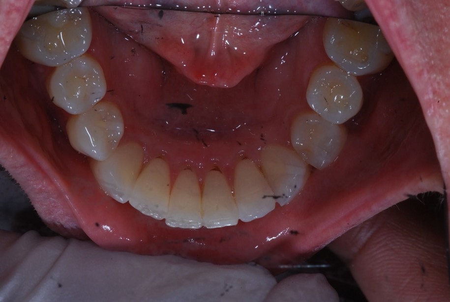 Inman aligner after, Wellington patient at Thorndon Dental