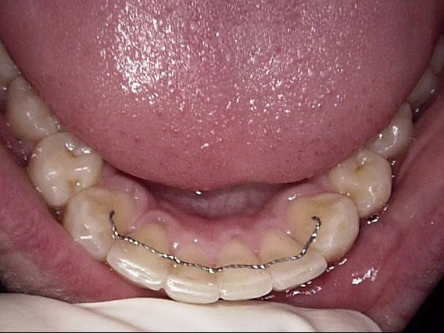 Inman aligner after, Wellington patient at Thorndon Dental
