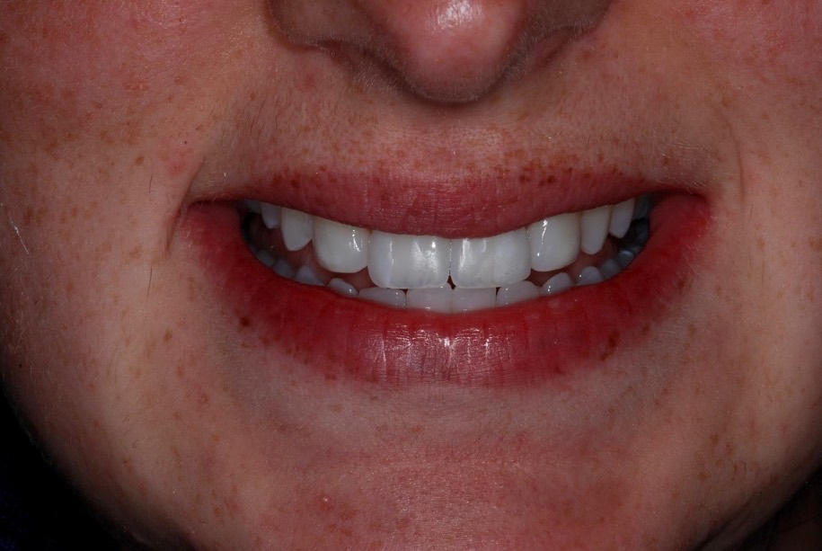 Inman aligner after, Wellington patient at Thorndon Dental
