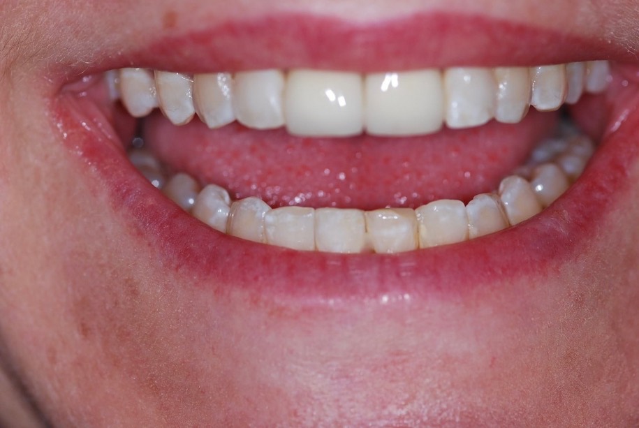 Inman aligner after, Wellington patient at Thorndon Dental