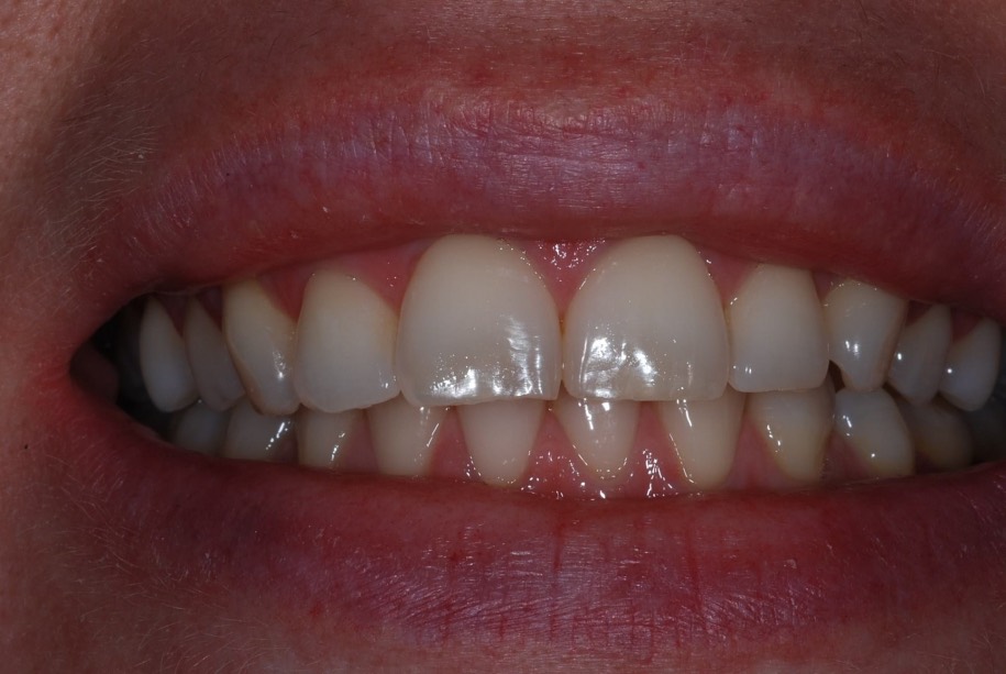 Inman aligner after, Wellington patient at Thorndon Dental