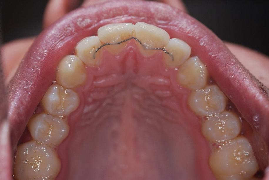 Inman aligner after, Wellington patient at Thorndon Dental