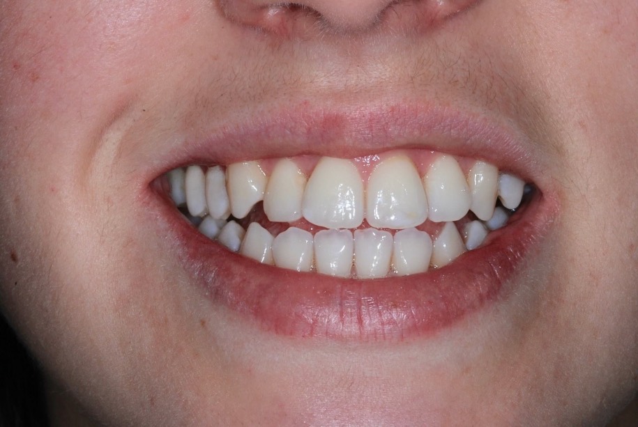 Inman aligner after treatment, Wellington patient at Thorndon Dental
