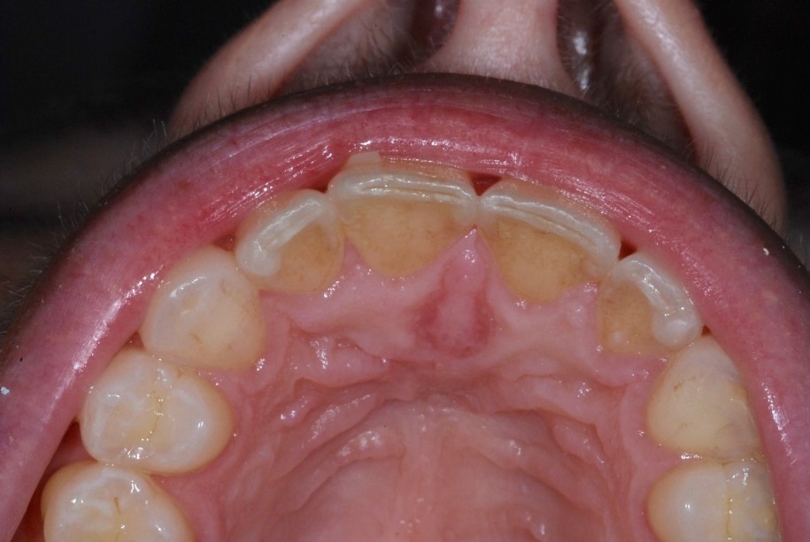 Inman aligner after, Wellington patient at Thorndon Dental