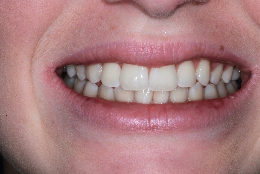 Inman aligner after, Wellington patient at Thorndon Dental