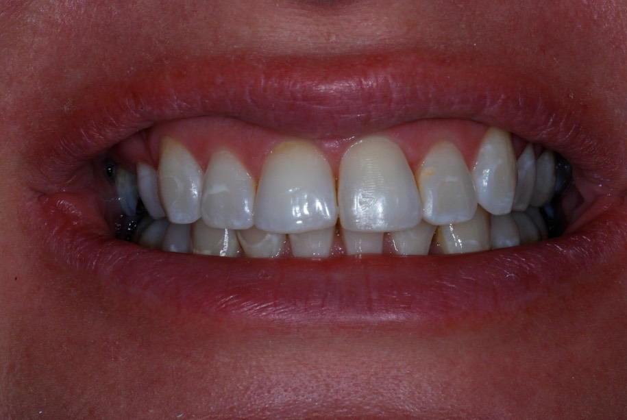 Inman aligner after, Wellington patient at Thorndon Dental