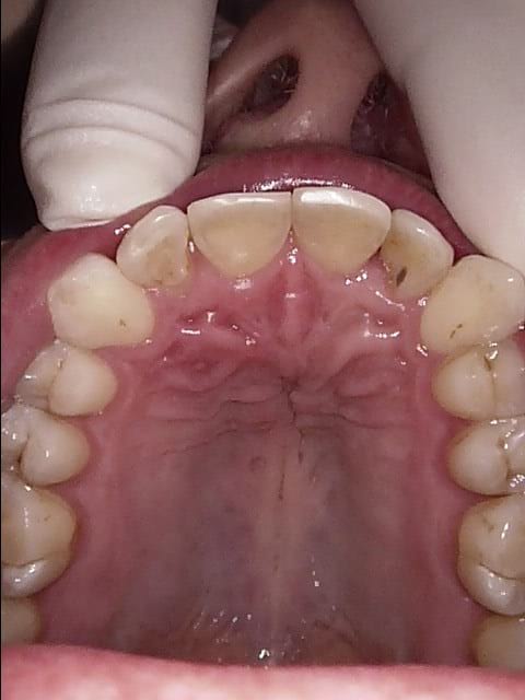 Inman aligner after, Wellington patient at Thorndon Dental