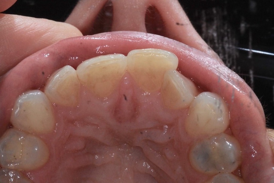 Inman aligner before, Wellington patient at Thorndon Dental