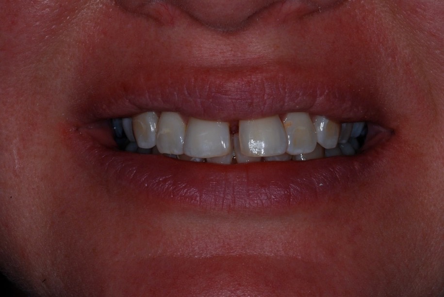 Inman aligner before, Wellington patient at Thorndon Dental