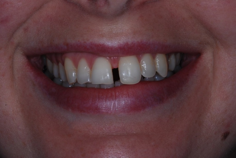 Inman aligner before, Wellington patient at Thorndon Dental