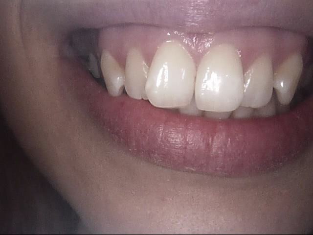 Inman aligner before, Wellington patient at Thorndon Dental