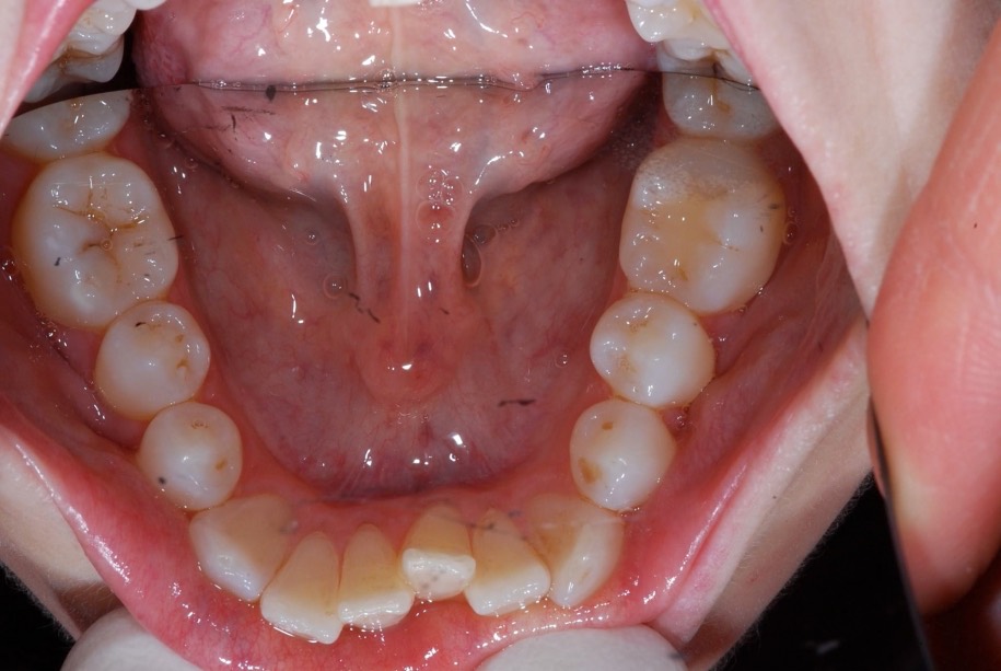 Inman aligner before, Wellington patient at Thorndon Dental