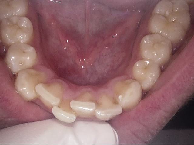 Inman aligner before, Wellington patient at Thorndon Dental