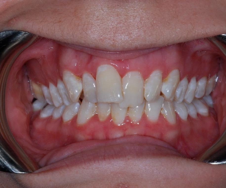 Inman aligner before, Wellington patient at Thorndon Dental