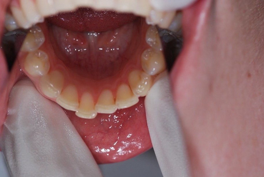 Inman aligner before, Wellington patient at Thorndon Dental