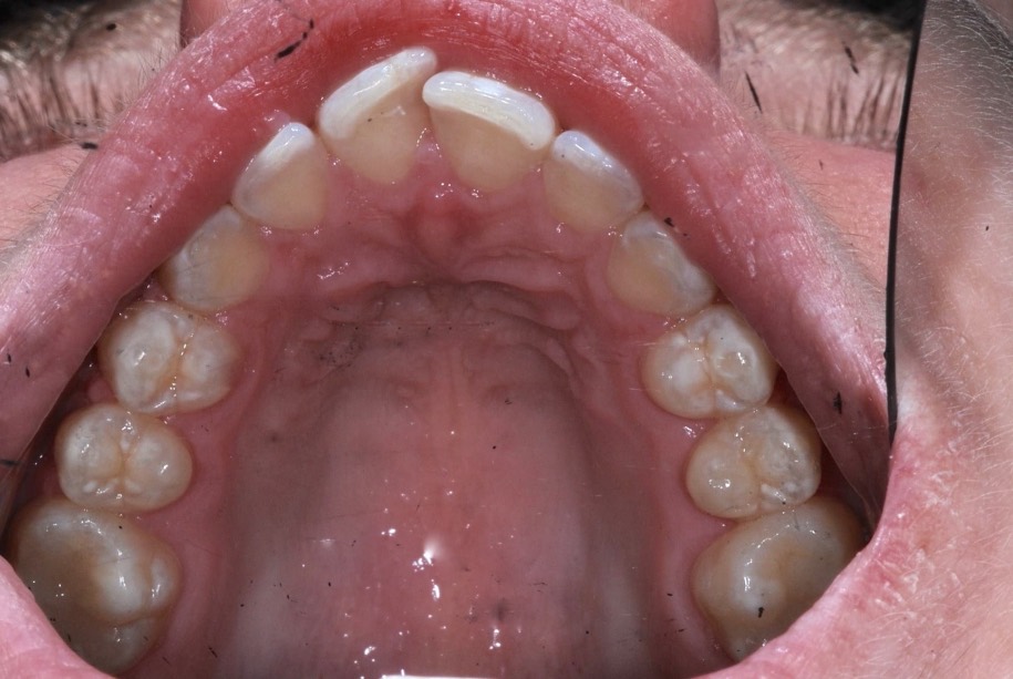 Inman aligner before, Wellington patient at Thorndon Dental