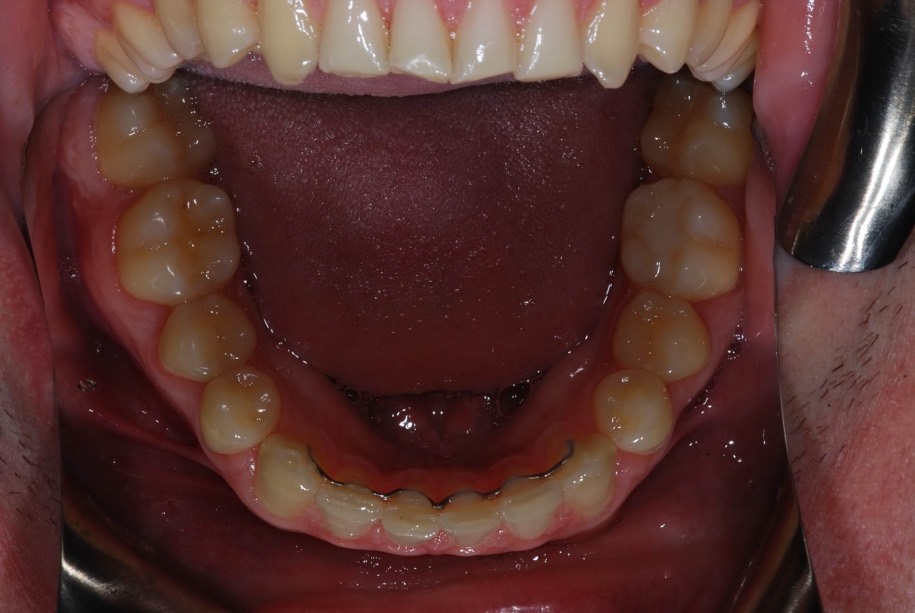 Invisalign after, Wellington patient at Thorndon Dental