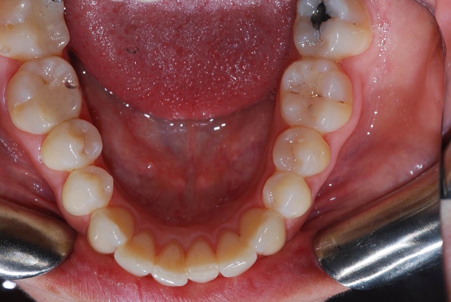 Invisalign before, Wellington patient at Thorndon Dental