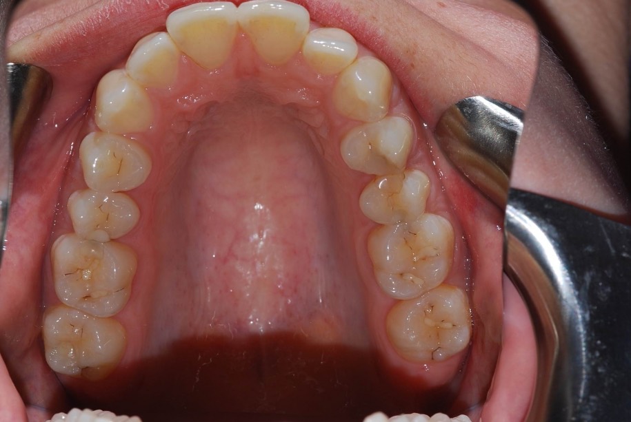 Invisalign before, Wellington patient at Thorndon Dental
