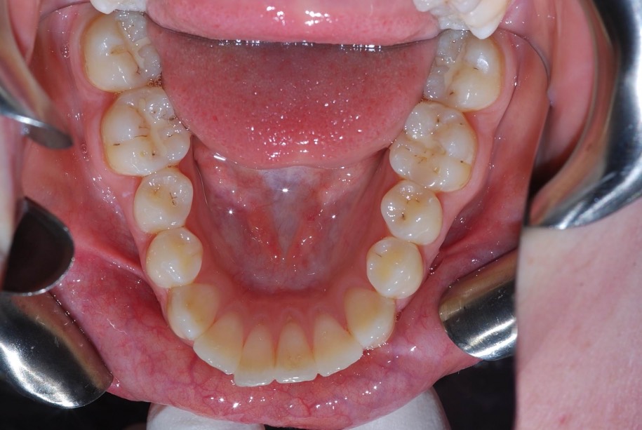 Invisalign before, Wellington patient at Thorndon Dental