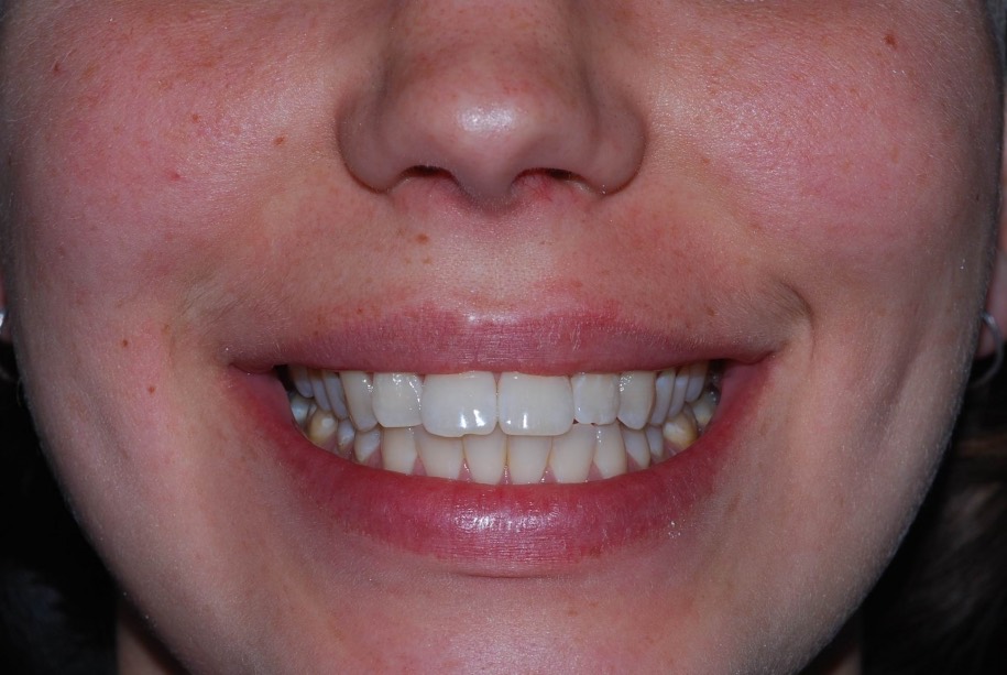 Invisalign before, Wellington patient at Thorndon Dental