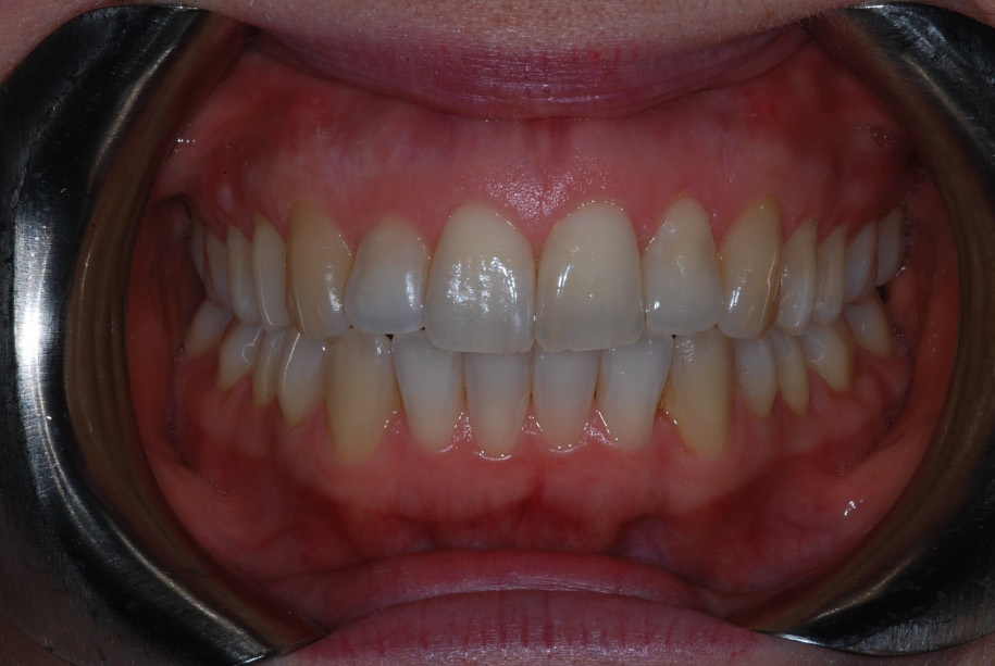 Invisalign after, Wellington patient at Thorndon Dental