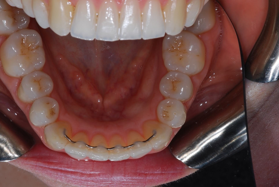 Invisalign after, Wellington patient at Thorndon Dental